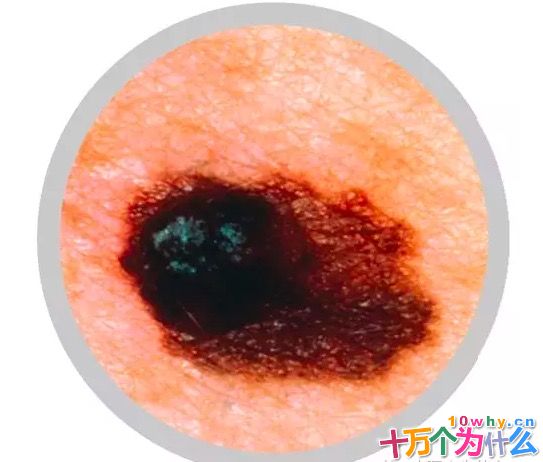 为什么过度日光浴会导致癌症