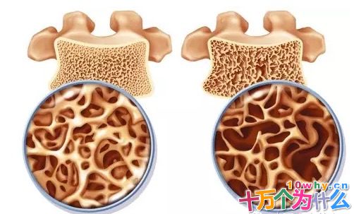 人老了为什么会驼背和变矮